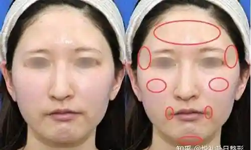 溶脂阵容额头插图